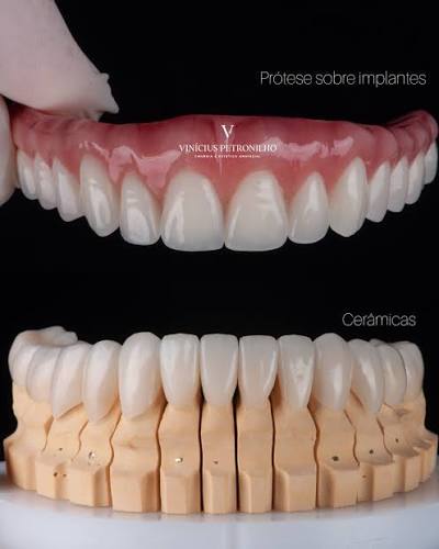 Prótese sobre implantes e coroas cerâmicas individualizadas