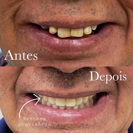 Antes e depois de reabilitação com prótese provisória sobre implantes