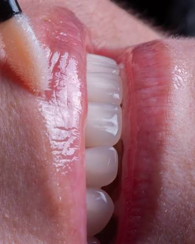 Detalhe do acabamento estético dos dentes após reabilitação