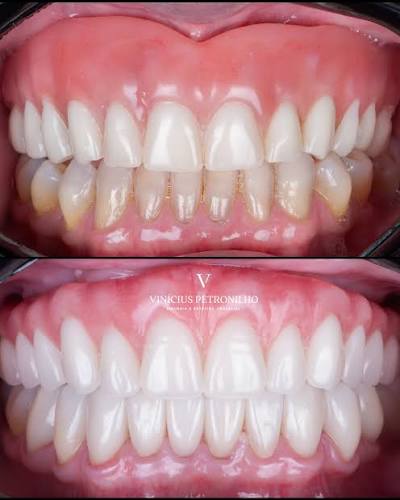 Antes e depois de reabilitação total superior e inferior