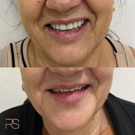 Antes e depois de tratamento reabilitador do sorriso